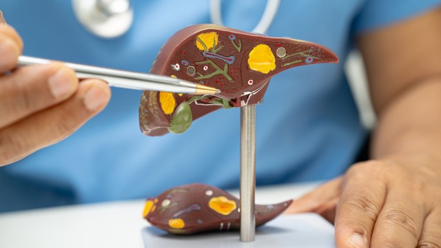 Gan nhiễm mỡ có nguy hiểm không? Triệu chứng, biến chứng và cách điều trị