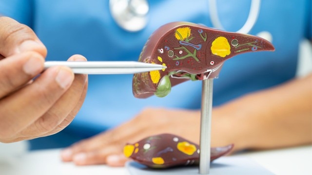 Gan nhiễm mỡ độ 2 có nguy hiểm không? Sự thật bạn nên biết