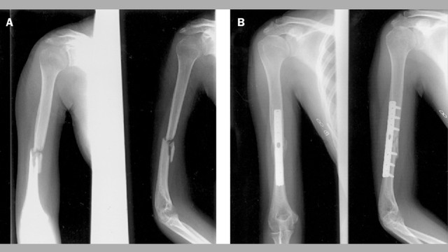 Gãy thân xương cánh tay có nguy hiểm không? Phương pháp điều trị và phục hồi hiệu quả