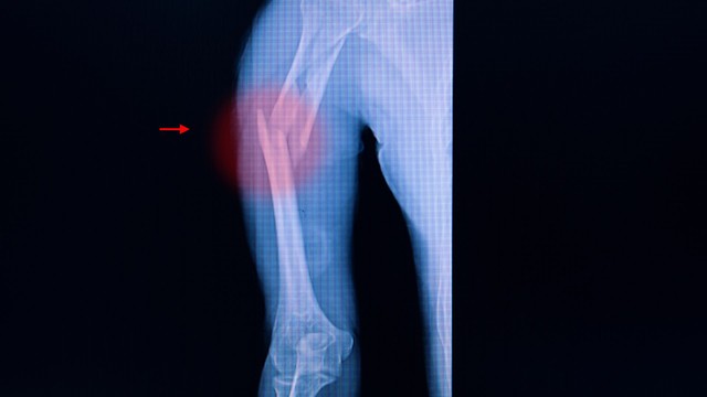 Gãy trên lồi cầu xương cánh tay: Nguyên nhân, điều trị và phục hồi