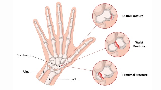 Gãy xương thuyền cổ tay: Dấu hiệu dễ bỏ qua và cách điều trị