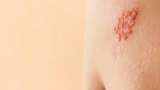 Ghẻ phỏng là gì? Nguyên nhân, triệu chứng và phòng ngừa hiệu quả