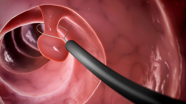 Giải đáp chi phí cắt polyp đại tràng và các yếu tố quyết định