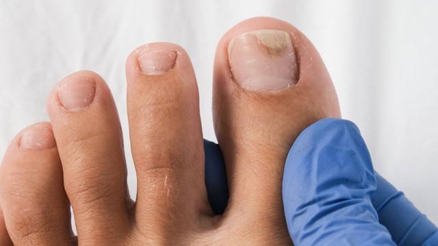 Giải phẫu móng chân: Cấu tạo, chức năng và bệnh lý thường gặp