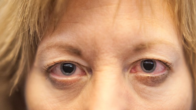 Giãn đồng tử là gì? Những thông tin cần biết