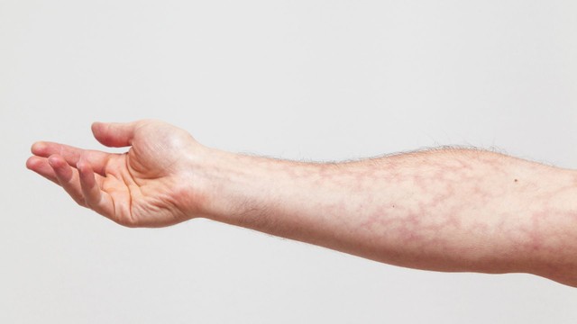 Giãn mao mạch là gì? Những điều cần biết về giãn mao mạch