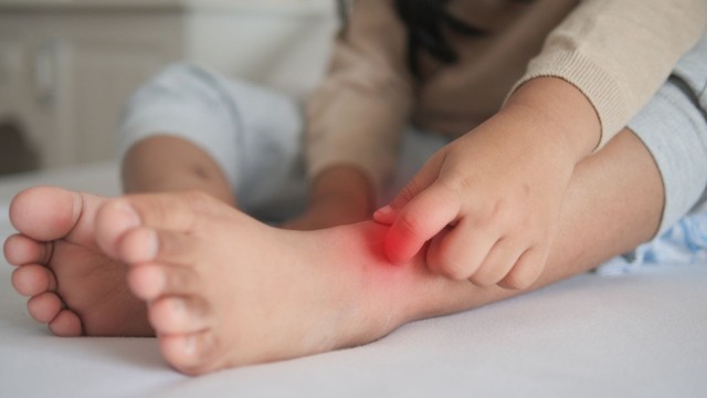 Hắc lào ở trẻ em: Nguyên nhân, triệu chứng và phương pháp điều trị