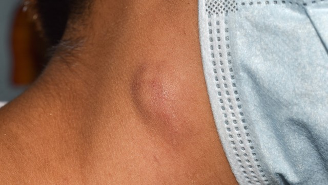 Hạch HIV có đặc điểm gì? Cách nhận diện và phân biệt với hạch thông thường