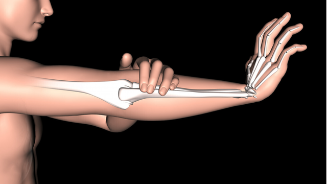 Hạt dưới da trong viêm khớp dạng thấp là gì?