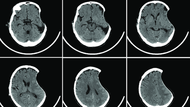 Hiện tượng lõm đầu ở người lớn: Nguyên nhân và cách chẩn đoán