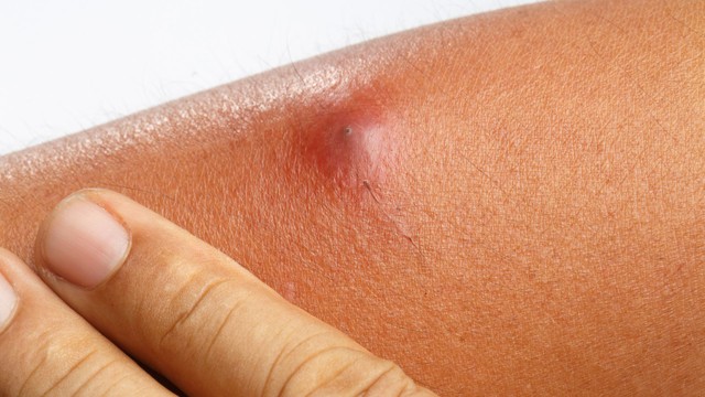 Hình ảnh bệnh ổ gà ở nách: Nhận biết sớm qua dấu hiệu điển hình