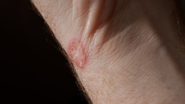 Hình ảnh lác đồng tiền: Nguyên nhân và cách phòng ngừa