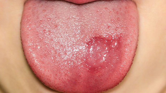 Hình ảnh lưỡi bị bệnh và những dấu hiệu cảnh báo sức khỏe quan trọng