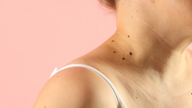 Hình ảnh nốt ruồi ung thư: Dấu hiệu nhận biết sớm và những thay đổi cần cảnh giác