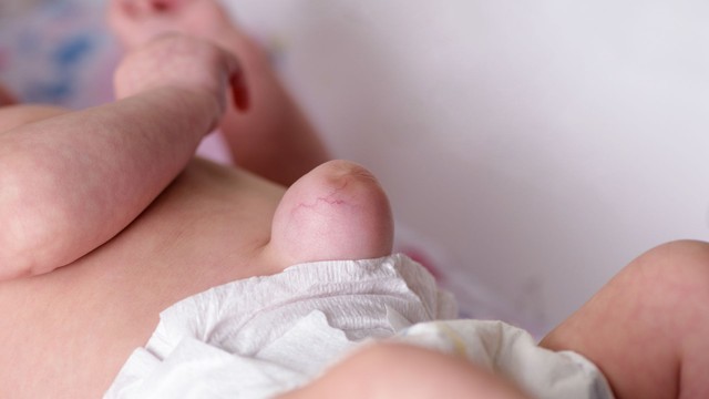 Hình ảnh rốn lồi ở trẻ sơ sinh: Nguyên nhân, cách nhận biết và xử lý