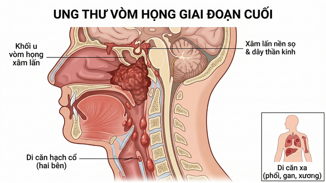 Hình ảnh ung thư vòm họng giai đoạn cuối: Dấu hiệu nhận biết và đặc điểm qua MRI, CT