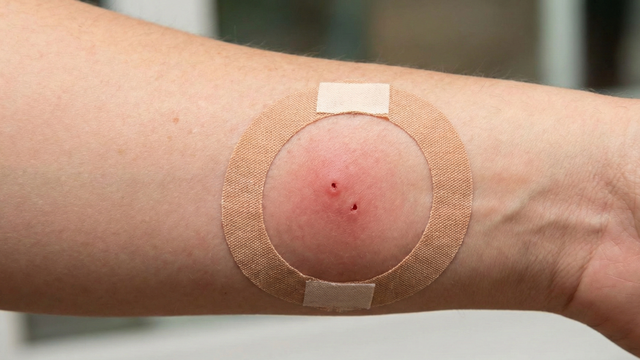 Hình ảnh vết chuột cắn: Cách nhận biết, mức độ nguy hiểm và xử trí đúng