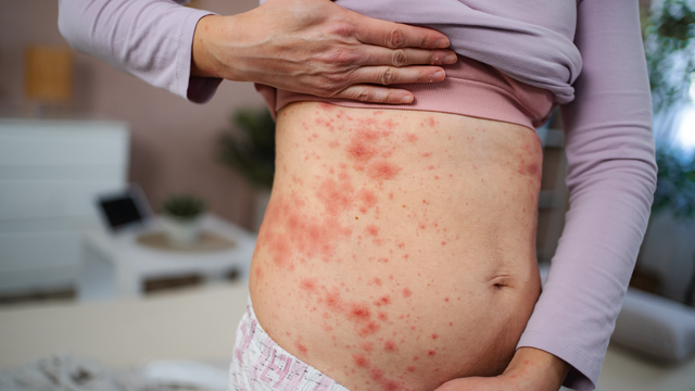 Hình ảnh viêm da tiếp xúc dị ứng: Nhận biết sớm qua các dấu hiệu trên da