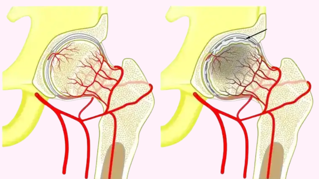 Hoại tử chỏm xương đùi là gì? Nguyên nhân và cách điều trị