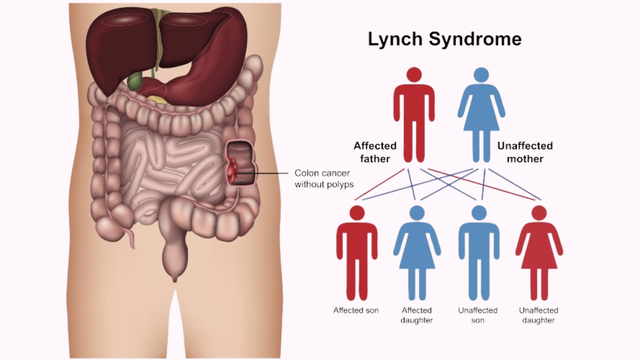 Hội chứng Lynch là gì? Cách chẩn đoán hội chứng Lynch
