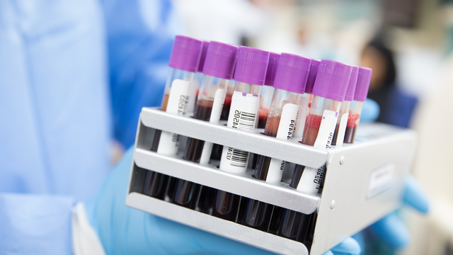 Hội chứng tăng bạch cầu ưa axit: Nguyên nhân và triệu chứng