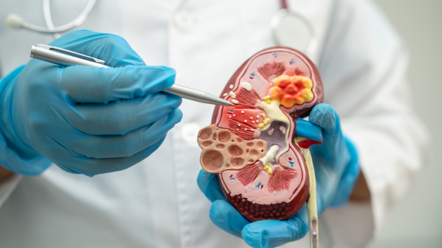 Hội chứng thận hư nên ăn gì để đủ albumin?