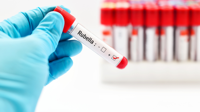 Kết quả Rubella IgM dương tính là gì? Cần làm gì khi có kết quả Rubella IgM dương tính?