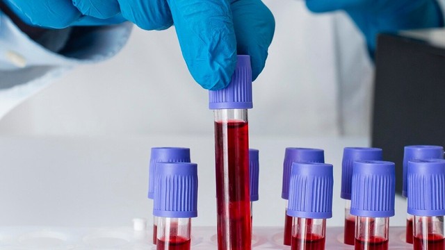 Làm gì khi kết quả xét nghiệm viêm gan B dương tính?