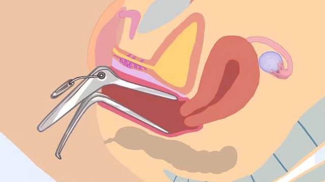Khám phụ khoa bằng mỏ vịt để làm gì? Khi nào cần thực hiện?