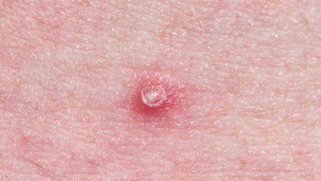 Khi cậu nhỏ nổi mụn trắng không ngứa​ có nguy hiểm không?