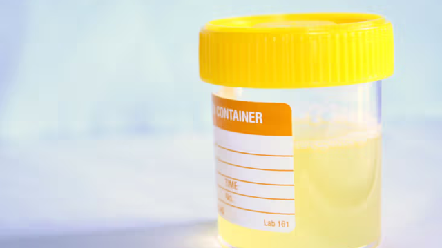 Khi nào cần cấy nước tiểu? Quy trình cấy nước tiểu diễn ra như thế nào? 