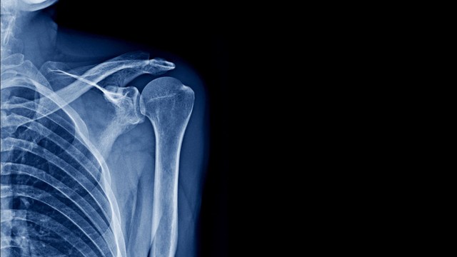 Khi nào cần chụp X-quang khớp vai và một số lưu ý bạn cần biết