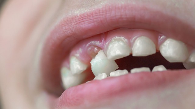 Khi nào trẻ thay răng sữa? Dấu hiệu thay răng ở trẻ