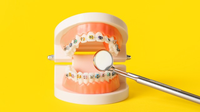 Khớp cắn ngược: Biểu hiện nhận biết sớm và giải pháp điều trị