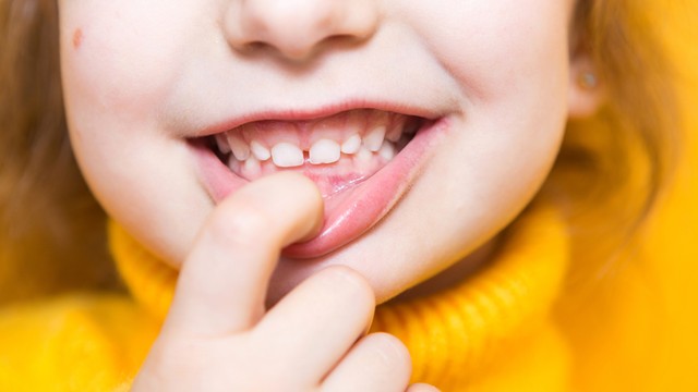 Khớp cắn sâu là gì? Những điều bạn cần biết để phát hiện và xử lý kịp thời