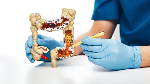 Kích thước polyp đại tràng 5mm​ có cần điều trị không?