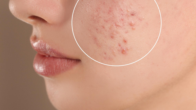 Phải làm sao để không bị mụn khi đến tháng?