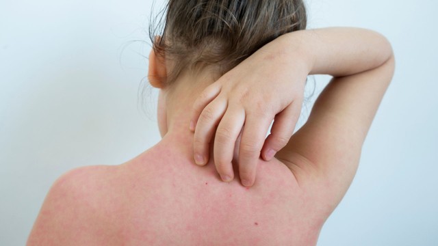 Lang ben ở lưng: Nguyên nhân, triệu chứng và cách phòng ngừa