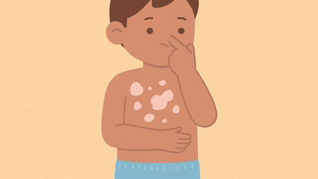 Lang ben ở trẻ em là gì? Những vấn đề cần biết về lang ben ở trẻ em