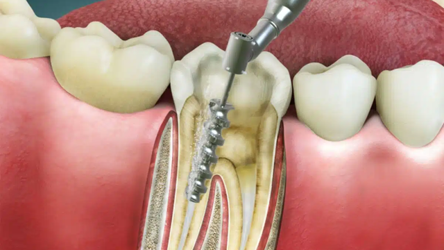 Lấy tủy răng mất bao lâu? Các yếu tố có thể gây ảnh hưởng