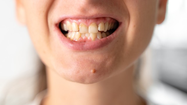 Lệch khớp cắn là gì? Khi nào cần can thiệp điều trị lệch khớp cắn?