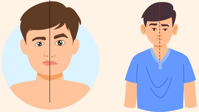 Liệt dây thần kinh số 7 trung ương là gì? Triệu chứng và cách chăm sóc