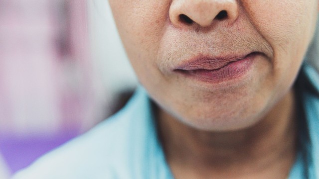 Liệt mặt ngoại biên: Nguyên nhân, dấu hiệu và cách điều trị