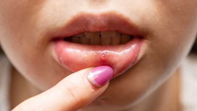 Lở loét miệng HIV: Nguyên nhân, xử trí và cách phòng ngừa