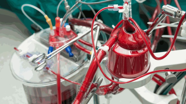 Lọc mỡ máu là gì? Ai nên lọc mỡ máu và những lưu ý khi lọc mỡ máu