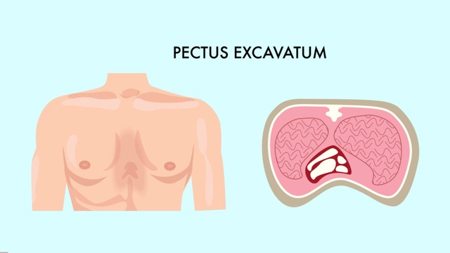 Lõm ngực bẩm sinh là gì? Những vấn đề cần biết về lõm ngực bẩm sinh
