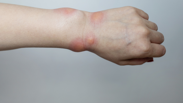 Mề đay phù mạch là bệnh gì? Cách kiểm soát triệu chứng hiệu quả