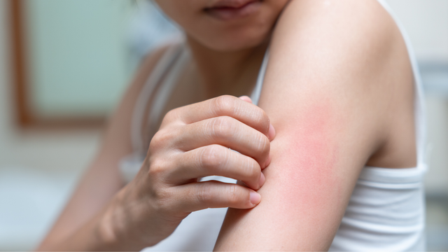 Men gan cao gây ngứa​ do đâu? Biểu hiện và cách phòng ngừa