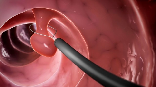Mổ polyp mũi kiêng ăn gì? Cảnh báo nhóm thực phẩm cần tránh