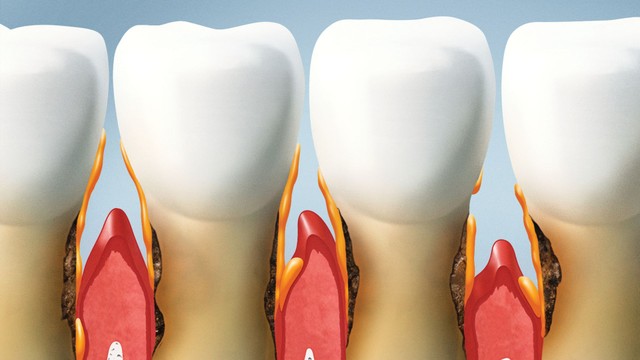 Mòn cổ chân răng là gì? Những điều cần biết về mòn cổ chân răng